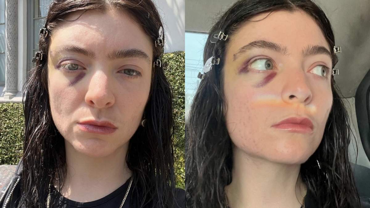 Fans Left Confused After Lorde Shares Selfies With A Black Eye: “Girl, What Happened to Your Face?”