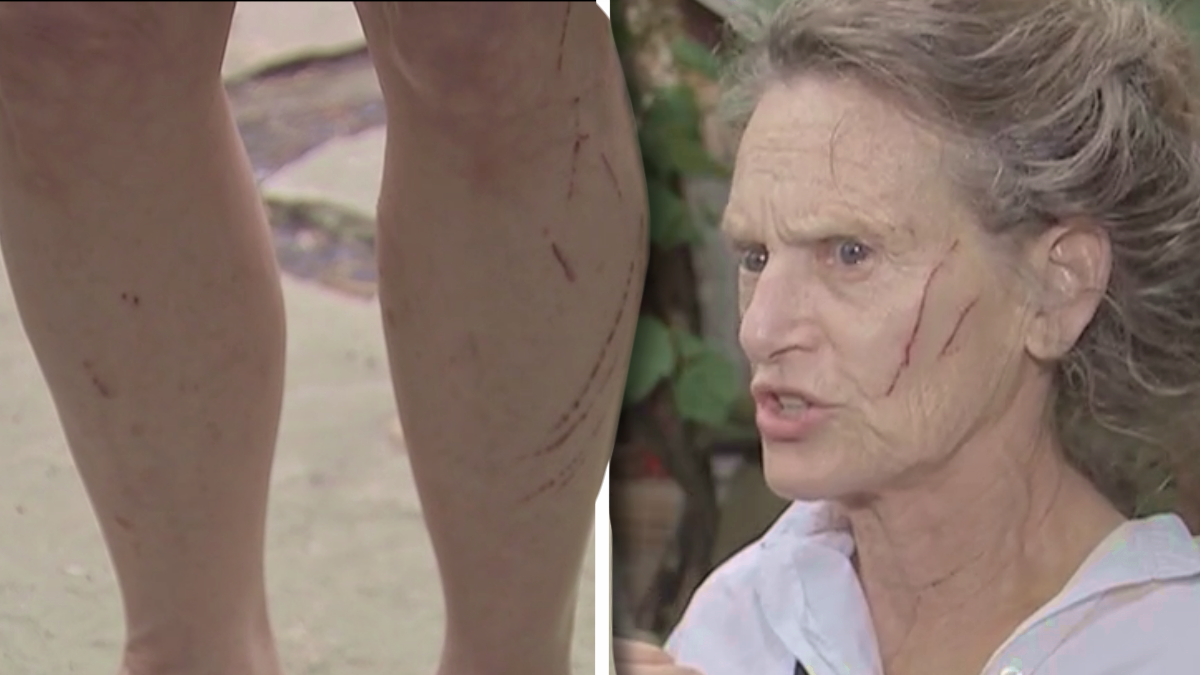 Massachusetts Woman Mauled by ‘Monster’ Raccoon on Her Porch After Spraying Coyote Urine in Her Garden: ‘It’s Called Wildlife for a Reason’