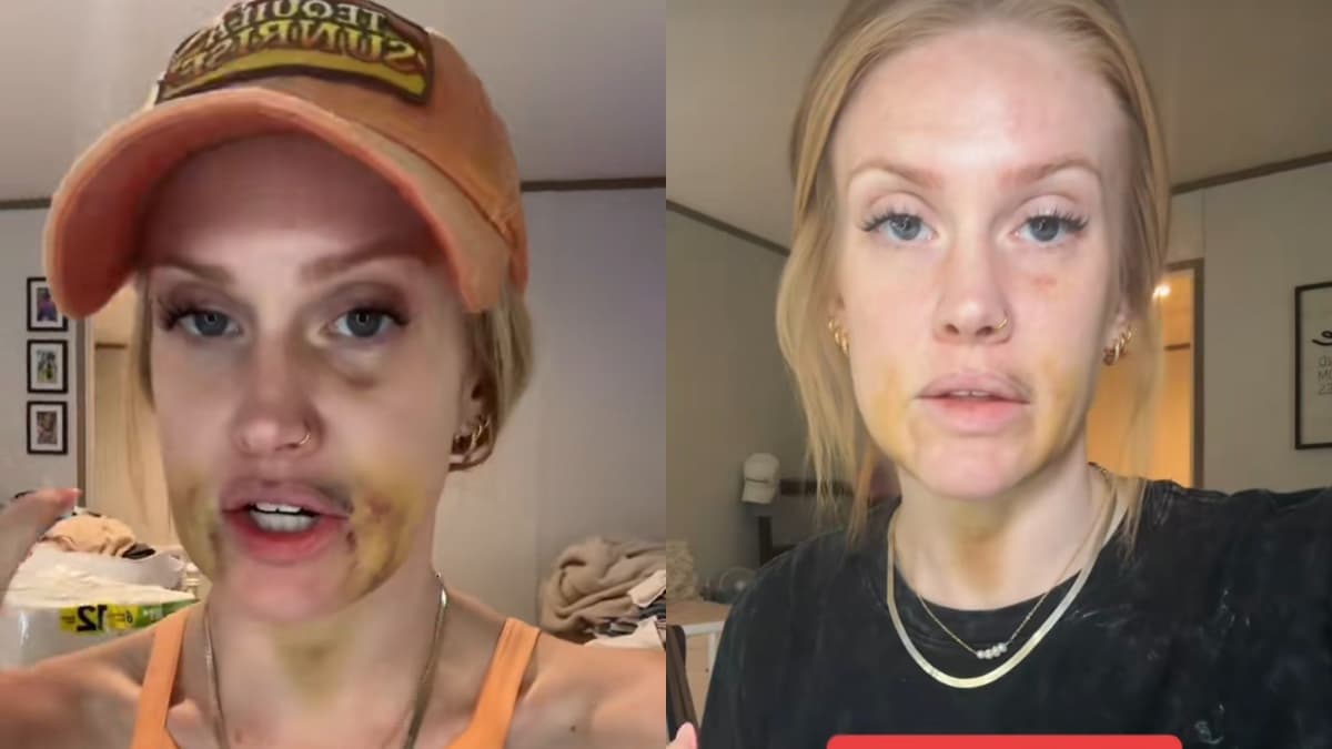 South Carolina Woman Left Black and Blue After Wisdom Teeth Surgery: ‘Were You Fighting the Dentist?!’